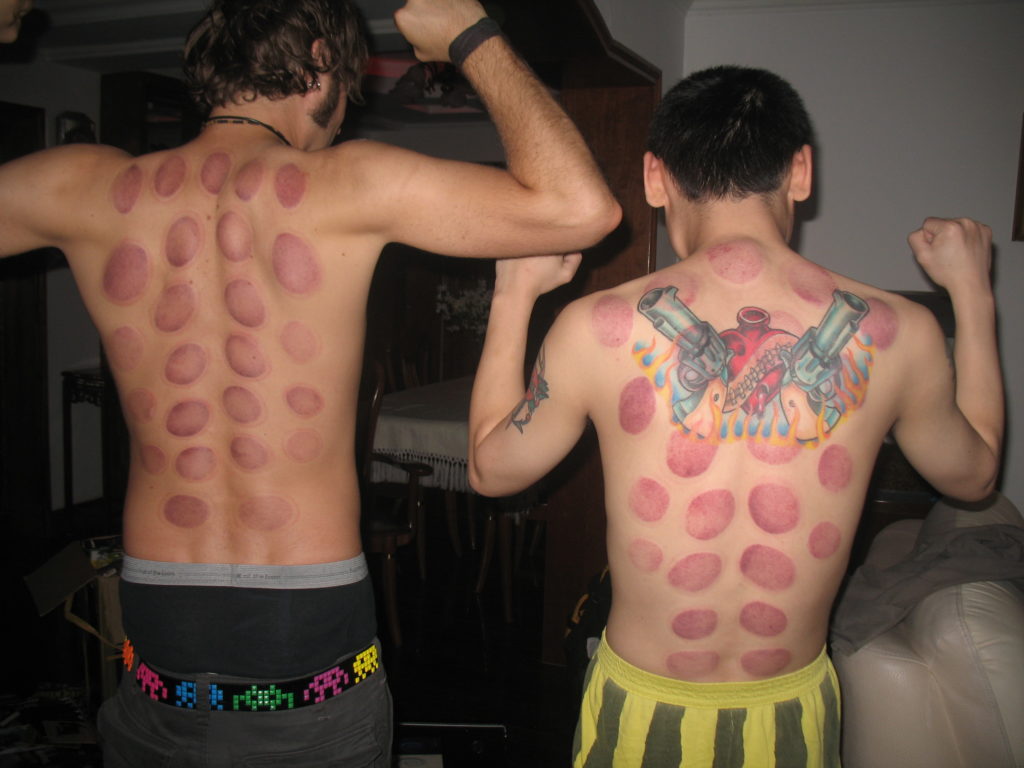 Cupping